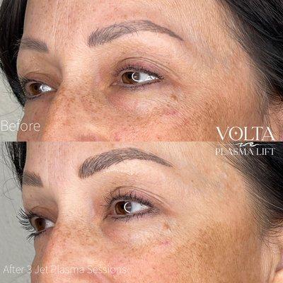 Jet Plasma Non-invasive skin tightening & brightening