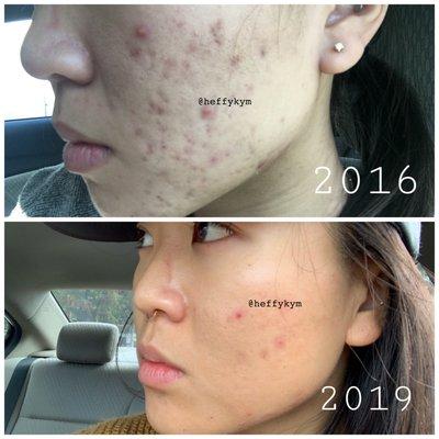 BEFORE&AFTER going to Eunice consistently once a month / extractions, 3 microneedling sessions, enzyme peels, & a good skincare routine