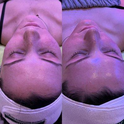 Before and after our Deluxe Hydrafacial