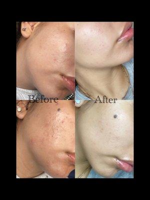 Before & after High Frequency treatment