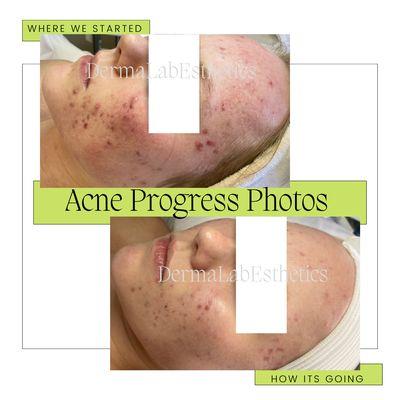 Acne facial treatment progress photos