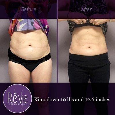 Fat loss before and after at Rêve Body Sculpting in Lexington KY