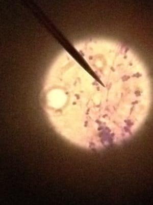 Budding yeast from an ear swab indicates a yeast infection.