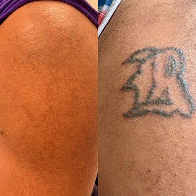 Tattoo Removal