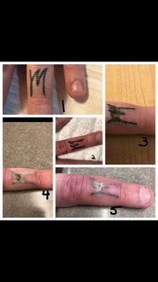 Tattoo removal