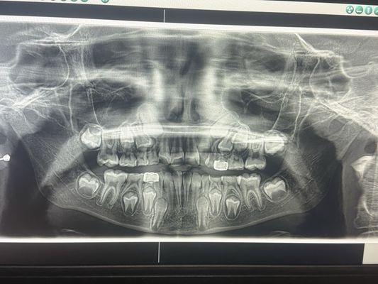 child's Xray