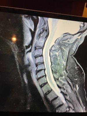 Cervical Spine