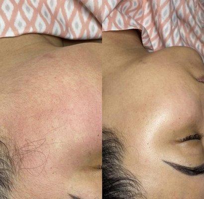 Microdermabrasion/Dermaplane Facial