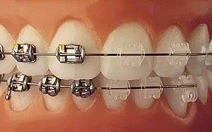 Clear and metal braces availble