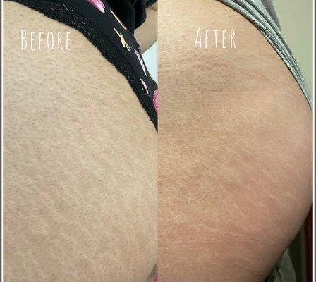 Stretch Mark Treatment