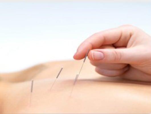 Dry needling is a proven modality to decrease pain, improve flexibility, and activate inhibited muscles.