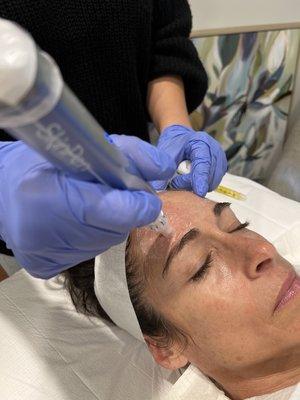 PRP microneedling with the SkinPen at Pure Health Encinitas.