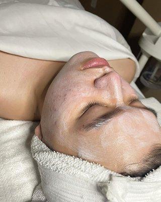 Acne facial