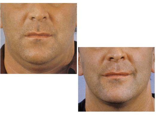 Get rid of your double chin permanently in just few sessions at Sulis Body Sculpting(480)506-6433.