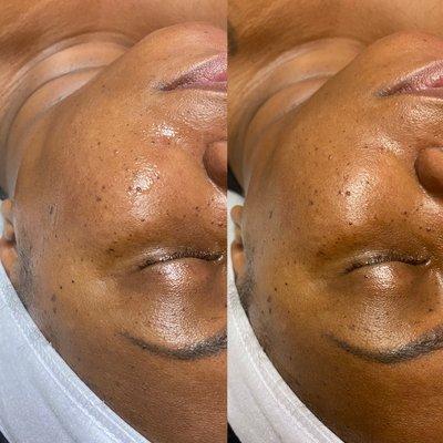 Facial before and after the glow on the right picture after finishing the facial.