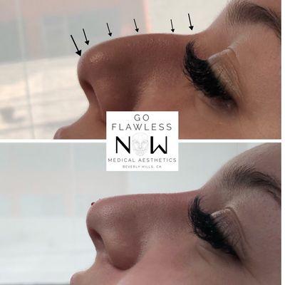 Non surgical nose