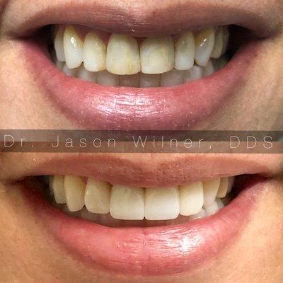 Porcelain Veneers on the front 4 teeth to compared to bondings. much more natural and beautiful smile.