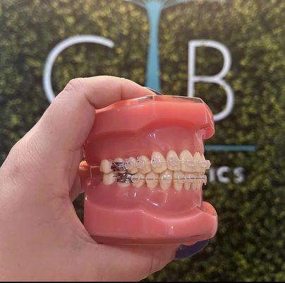 Ceramic braces are ideal for patients who seek the functionality of traditional metal braces but with more discreet look!