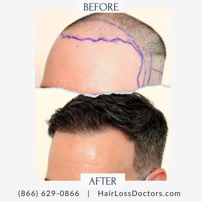 Male Before / After Sample from The Hair Loss Doctors By Robert J. Dorin with Surgical Headquarters in Garden City, NY.