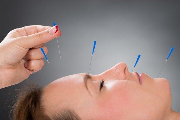 Acupuncture Facial rejuvenation.