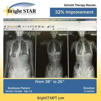 Schroth for Scoliosis Before & After