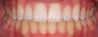 Custom Whitening