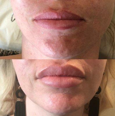 Lip Injections using Restylane Silk