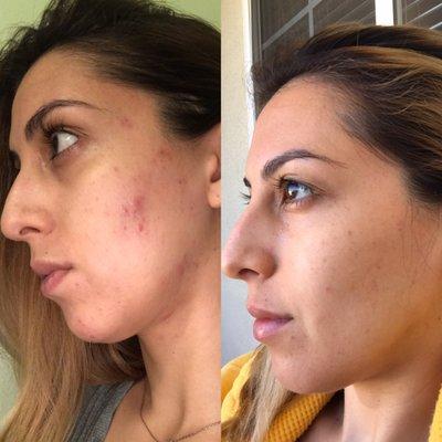 Before May 2017, After October 2017 in just a matter of months @theesthyclinic gave me clear soft and radiant skin!