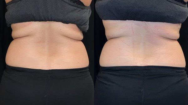 Results immediately after Non-Invasive Laser Lipo