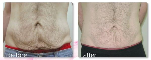 Skin Tightening after significant weight loss - Reaction Refit