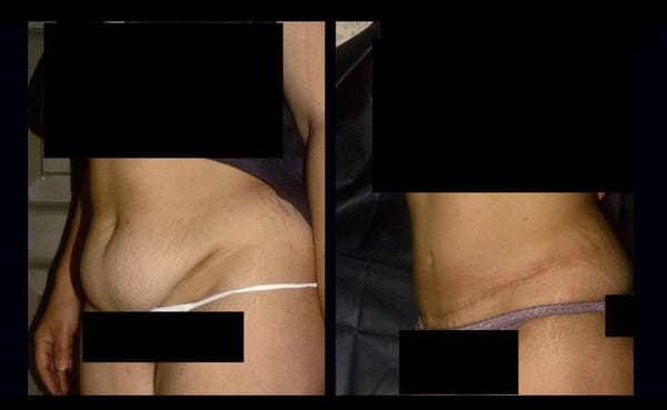 Abdominoplasty