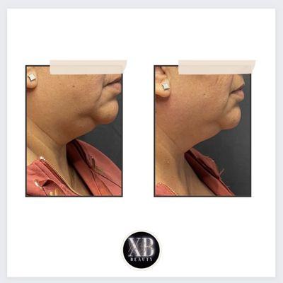 "Bye bye, double chin! ## Say hello to my new secret weapons for a chiseled look! Radio frequency non-invasive treatment for the win!