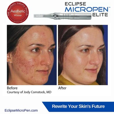 Treatment with minimal down time for acne scars, fine lines, improvement in complexion