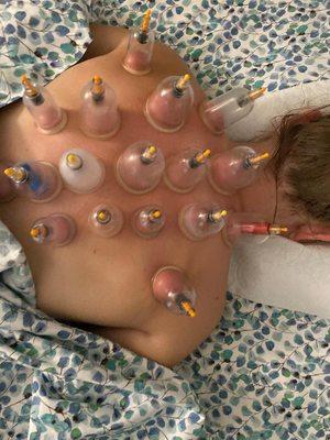 cupping therapy