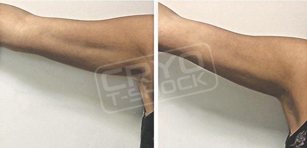 Arm fat removal before and after