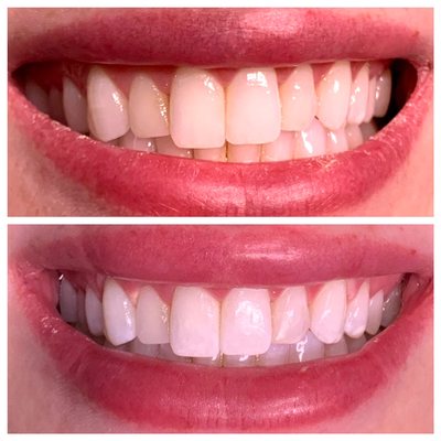 Teeth whitening before and after