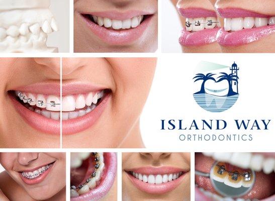 You can choose metal, clear, or lingual braces. We also offer invisalign as a treatment option to patients.