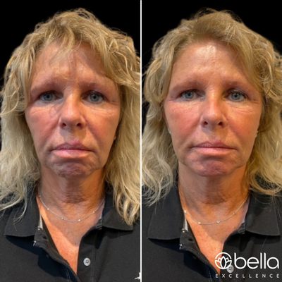 Fillers and Botox for this sweet lady. "I love it!"