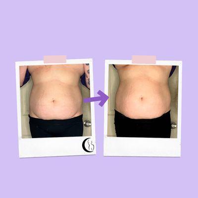 Before and after results of our Bloat Therapy service.