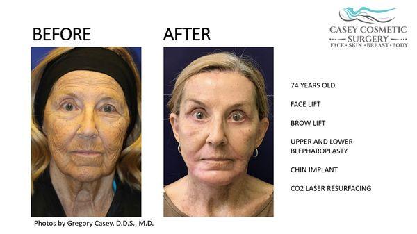 Amazing FaceLifts!