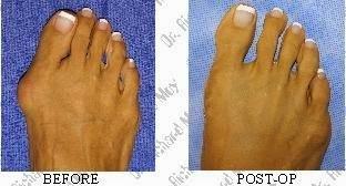 Bunion Surgery: Pain Free!!