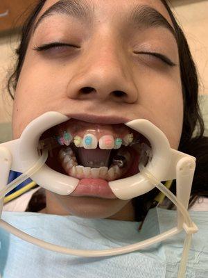 Candy color braces