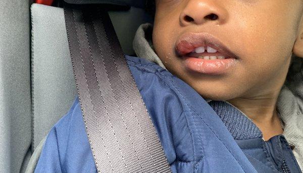 A busted swollen lip my almost 2 year old sustained while in the care of Little lights of the world daycare belonging to Bethel