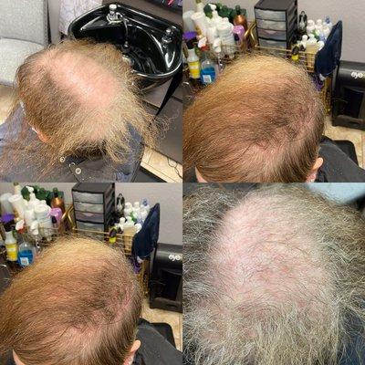 This woman had this issue for 20years was able to grow it back in 6months