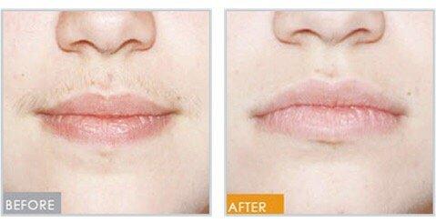 Laser hair removal for upper lip before and after.