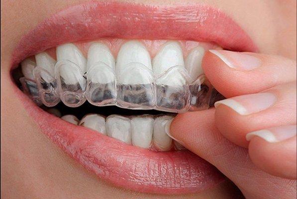 Custom Whitening Trays