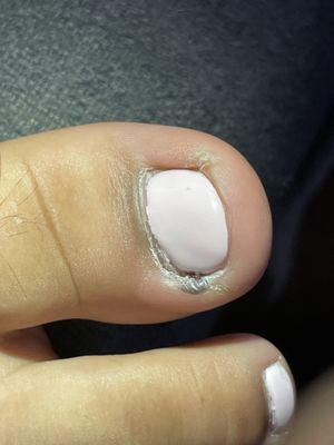 Infection swollen toe