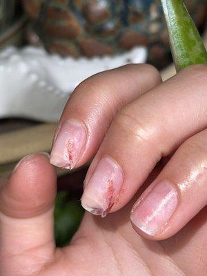 Broken nail and bleeding nail