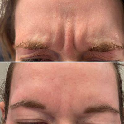 Glabella treatment with neurotoxin.