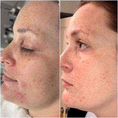 Before & After 1 chemical peel